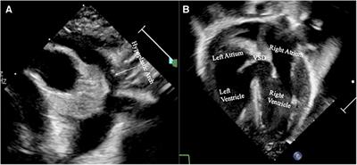 Frontiers Case Report A Novel Combination Of Anomalies In A Patient With Q Deletion